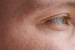 Milia (Milium) - pimples around eye on skin. Eyes of young man with small papillomas on eyelids or growths on skin. Face closeup.